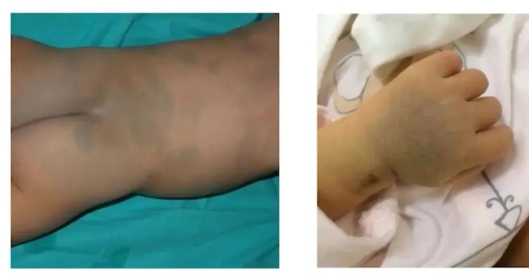 蒙古斑.jpg 蒙古斑.jpg