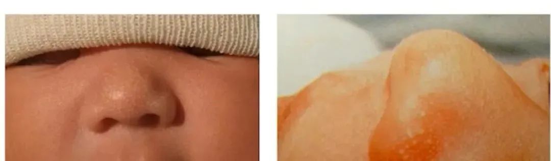 新生兒皮脂腺增生.jpg 新生兒皮脂腺增生.jpg