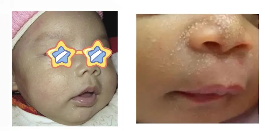 栗丘疹.jpg 栗丘疹.jpg