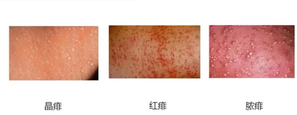 新生兒熱疹(痱子).jpg 新生兒熱疹(痱子).jpg